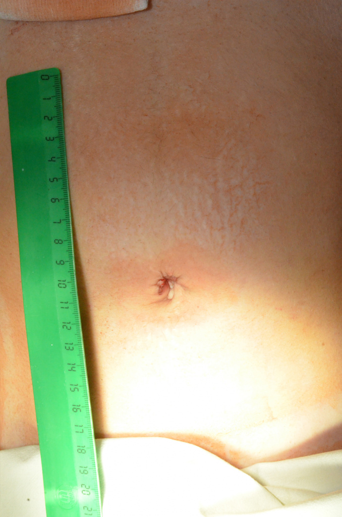 Рана после лапароскопии через 7 дней после операции