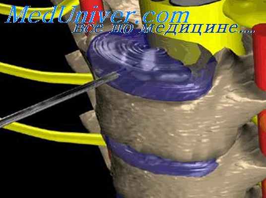 спинальные операции