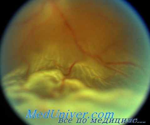 пневморетинопексия
