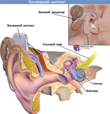 Кохлеарный имплант