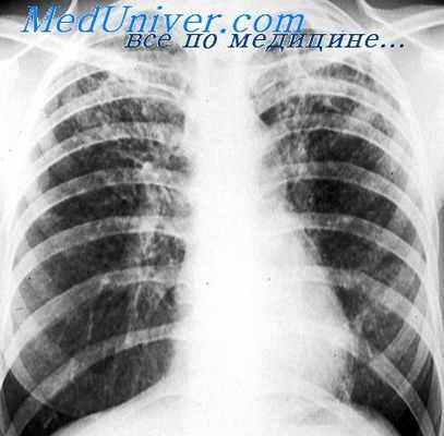 гнойный трахеобронхит