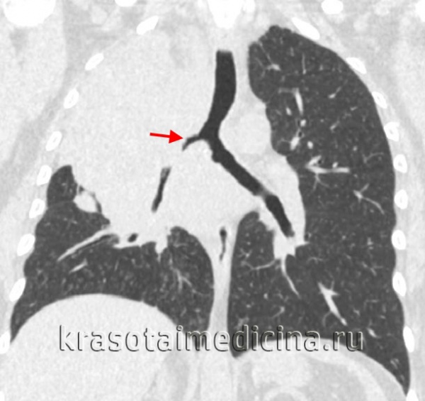 КТ органов грудной клетки. Ателектаз верхней доли правого легкого, обусловленный злокачественной опухолью правого верхнедолевого бронха