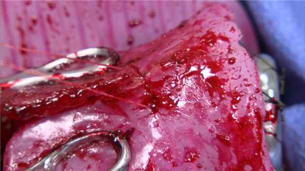 Восстановление шейки матки при ее разрыве