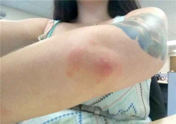 Проявление укуса клопа — волдырь около 2-5 мм