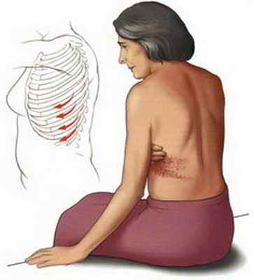 Постгерпетическая невралгия