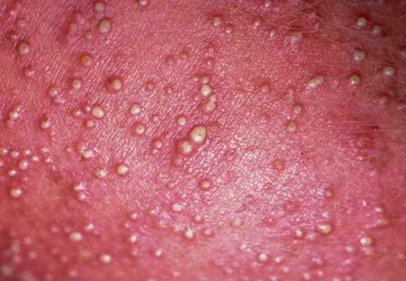 Везикулопустулёз