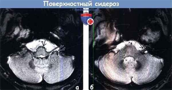 Поверхностный сидероз на МРТ