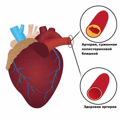 Склероз сосудов.jpg
