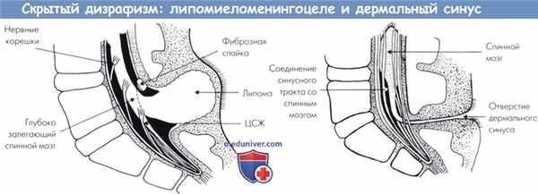 Скрытый дизрафизм - липомиеломенингоцеле и дермальный синус
