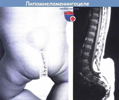 Липомиеломенингоцеле