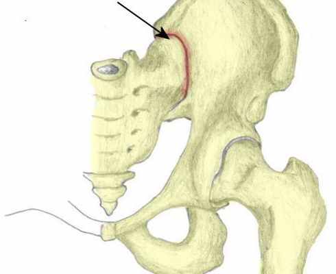 Крестцово-подвздошное сочленение: симптомы проявления и схема лечения