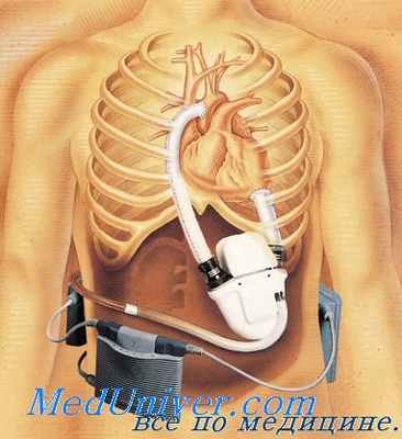 правожелудочковая недостаточность
