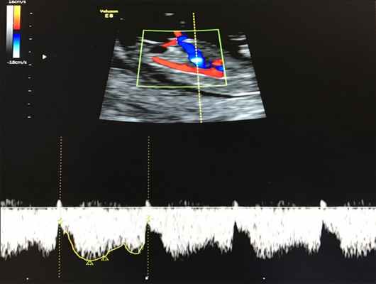 кровоток в венозном протоке