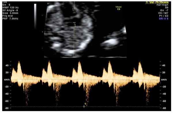 кровоток через трикуспидальный клапан