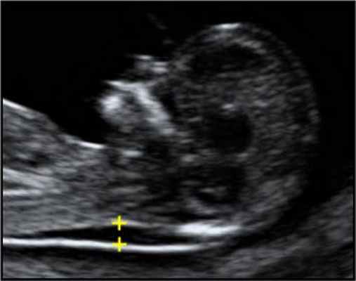 ТВП в норме