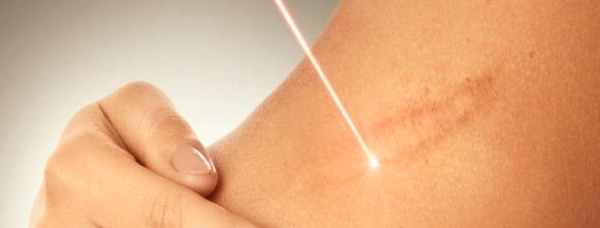 келоидные рубцы причины возникновения