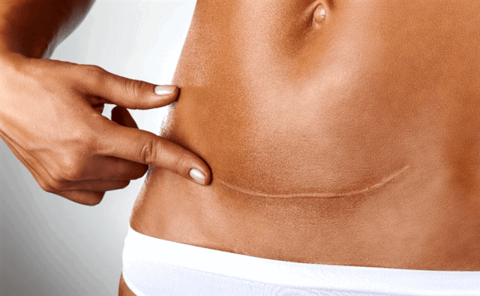 как избавиться от келоидного рубца