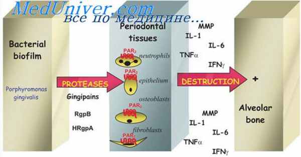 воспаление пародонта
