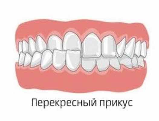 перекрестный прикус