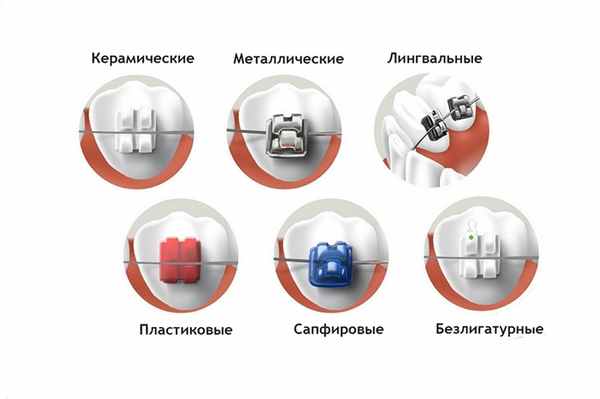 Виды брекетов
