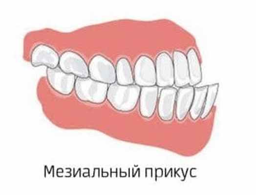 мезиальный прикус