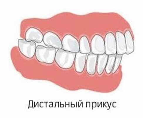 дистальный прикус