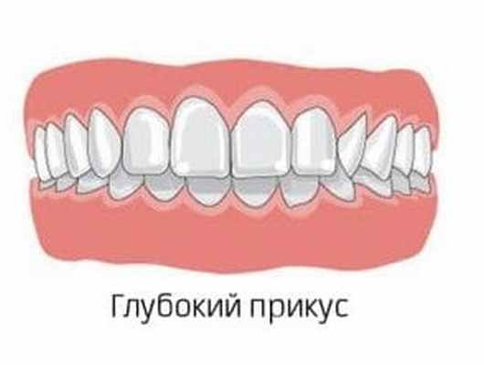 глубокий прикус