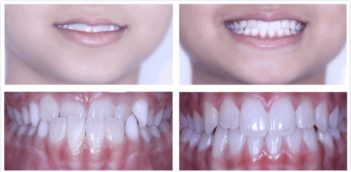 Виды прикуса человека - классификация, особенности лечения