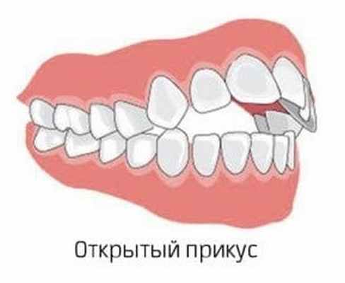 открытый прикус