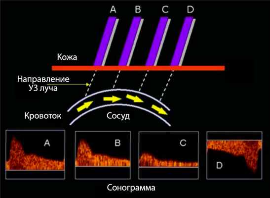 Сонограмма - Допплеровские эпюры УЗ