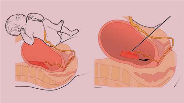 Плотное прикрепление или приращение плаценты
