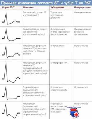 Причины изменения сегмента ST и зубца T на ЭКГ