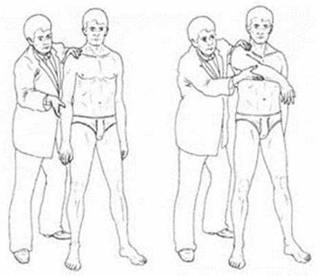 Симптом импиджмента Neer