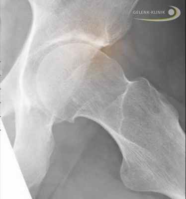 Бедренный тип (cam) импинджмент-синдрома тазобедренного сустава. Неправильная морфология слияния головки и шейки бедренной кости. Костное возвышение на головке бедренной кости, которое поражает вертлужную впадину (Acetabulum) (показано красным). © Gelenk-Klinik.de