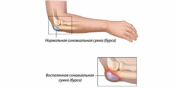 Воспаление сумки локтевого сустава при бурсите