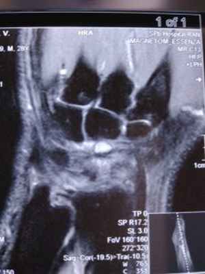 Гигрома запястья: причины и лечение