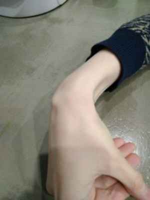 Гигрома запястья: причины и лечение