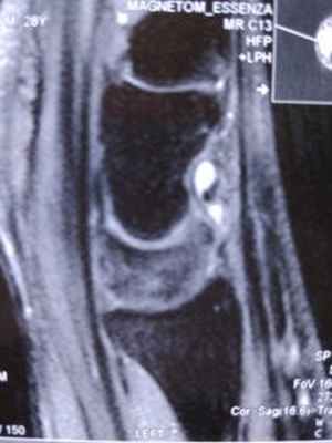 Гигрома запястья: причины и лечение