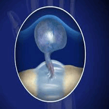 Гигрома запястья: причины и лечение