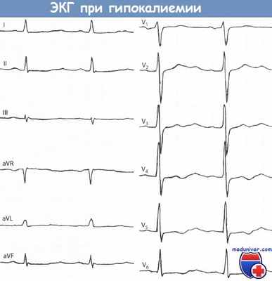 ЭКГ при гипокалиемии