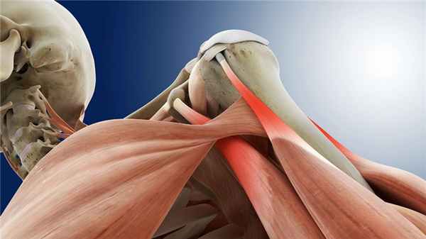 Тендинит плечевого сустава