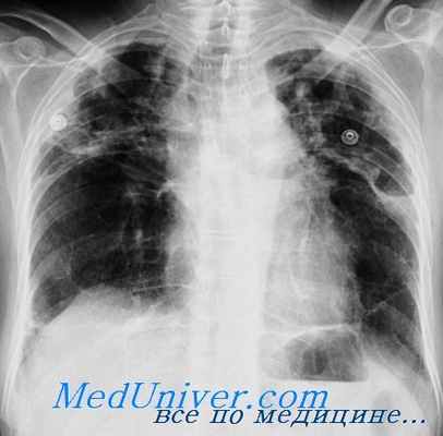 рентгенограмма при легочной гипертензии