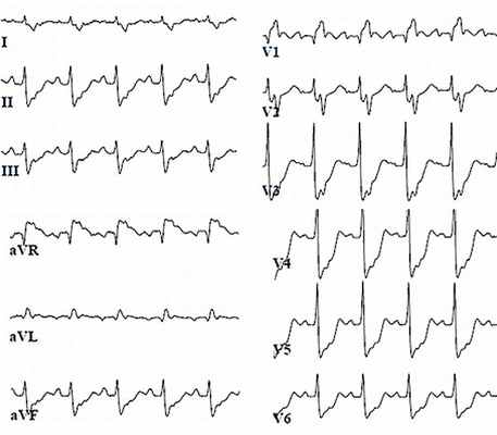 Электрокардиограмма при миокардите