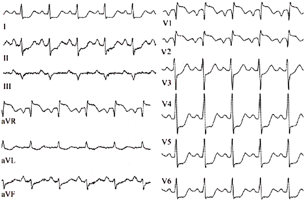 ЭКГ при коронавирусном миокардите