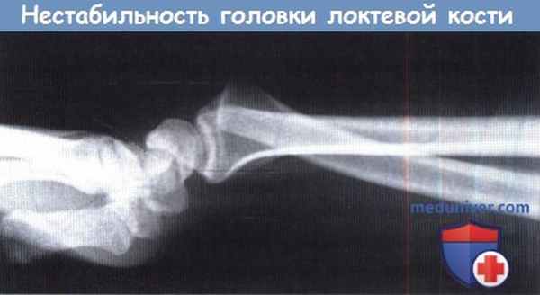 Нестабильность головки локтевой кости