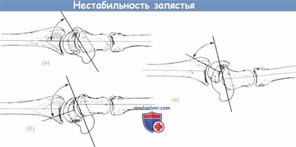 Схема нестабильности запястья