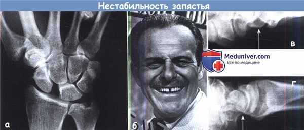 Нестабильность запястья