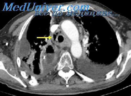 нейрогенные опухоли