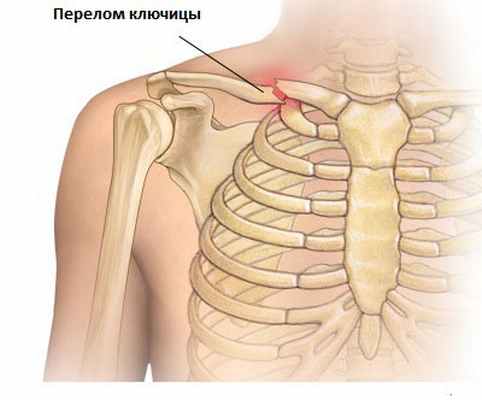 Перелом ключицы