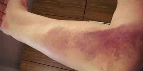 травма локтевого сустава